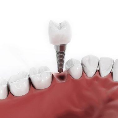 Dental implant detail clipart