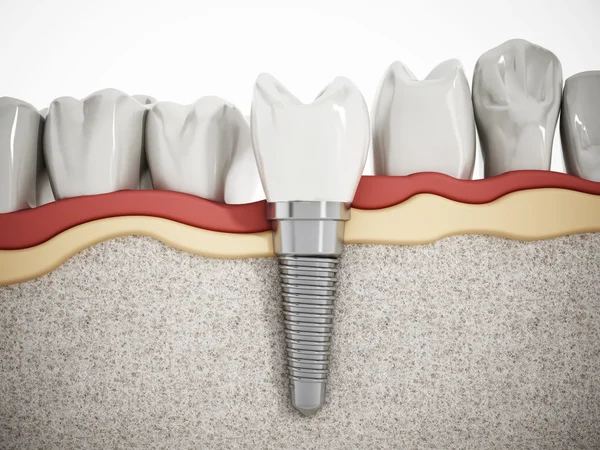Dental implant detay