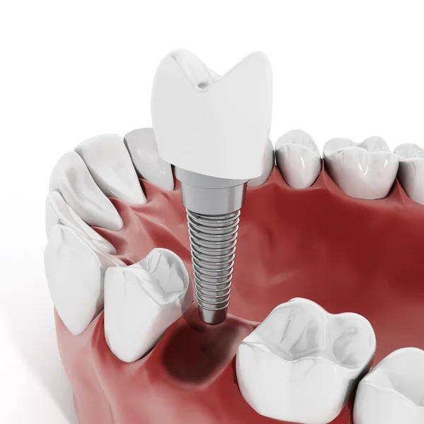 Dental implant detail — Stock Photo, Image