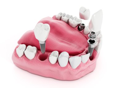 Dental implant detay