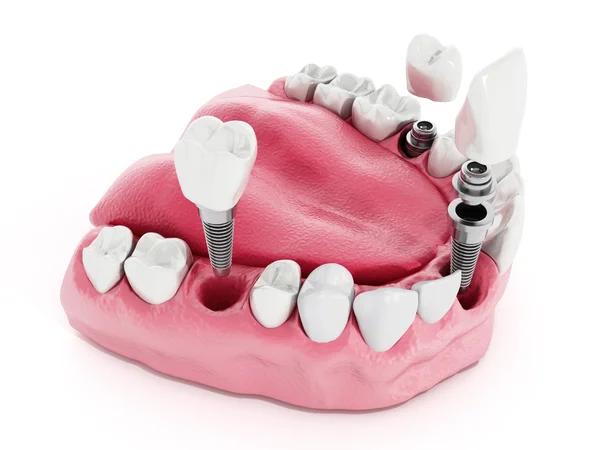 Fogászati implantátum-részlet — Stock Fotó