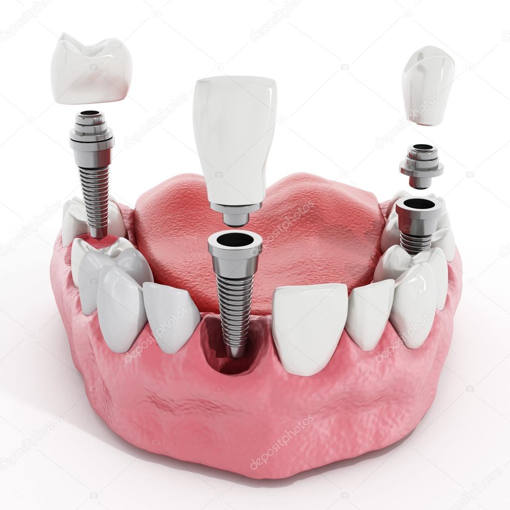 Dental implant detail