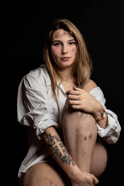 Studio Portrait Young Girl Bruises Her Skin Girl Wearing White — Stock Photo, Image