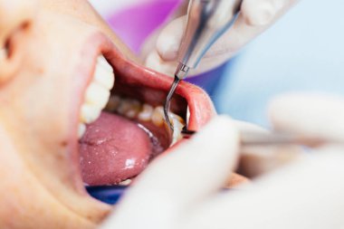 Diş hekimi bir hastanın ağzında diş bakımı yapıyor. Diş tedavisinin yakın plan görüntüsü.