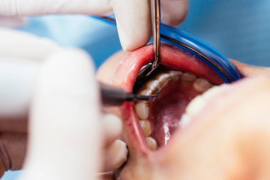 Diş hekimi bir hastanın ağzında diş bakımı yapıyor. Diş tedavisinin yakın plan görüntüsü.