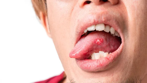Uomo Asiatico Ulcere Aftose Sulla Lingua Sfondo Bianco Messa Fuoco — Foto Stock