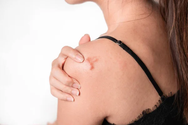 Las Mujeres Asiáticas Tienen Cicatriz Queloide Hombro Tacto Mano Sobre — Foto de Stock