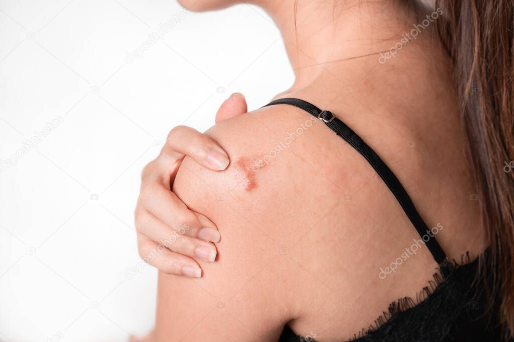 Asian women have keloid scar on shoulder and hand touch, on white background, dermatology and cosmetology concept.