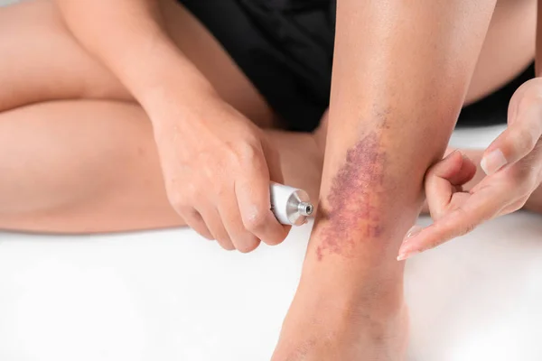 Asian women have bruise on leg from accident and use medicine cream on her skin, on white background.