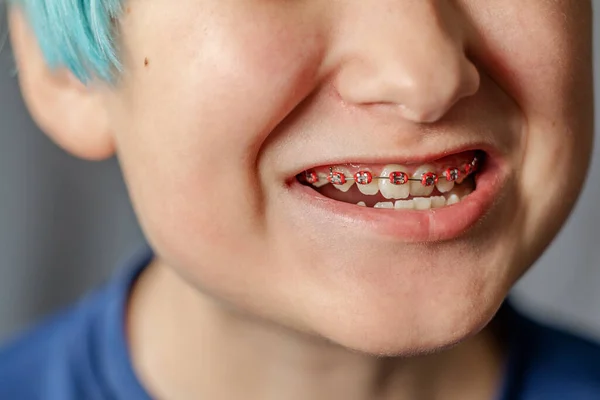 Teeth Teenager Braces Close Concept Oral Hygiene Health Care — Stock Photo, Image