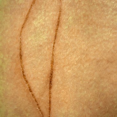 İnsan derisi üzerinde aşınma