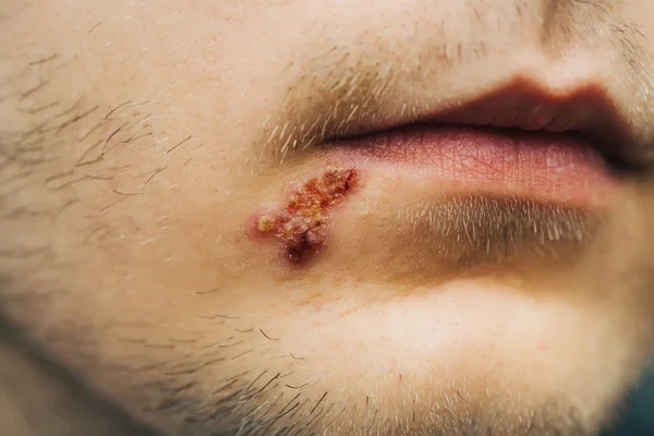 Boca masculina com herpes ou úlcera — Fotografia de Stock