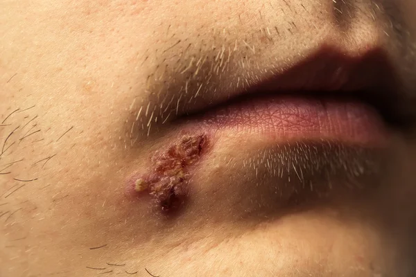 Männlicher Mund mit Herpes oder Geschwüren — Stockfoto