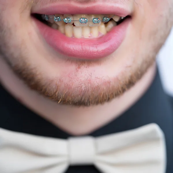 Male mouth with bracket — Stock Photo, Image