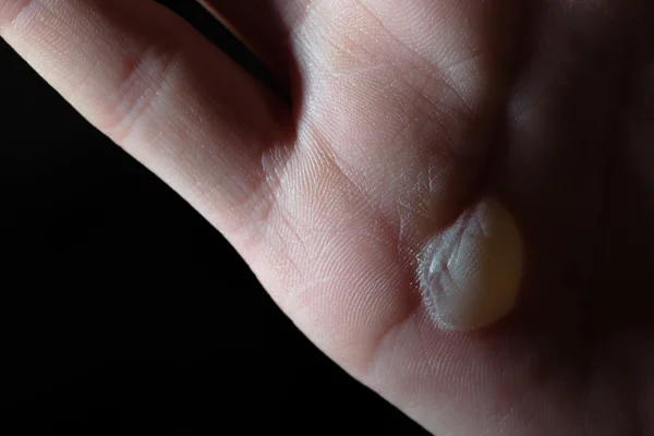 Human palm with blister on skin — Stock Photo, Image