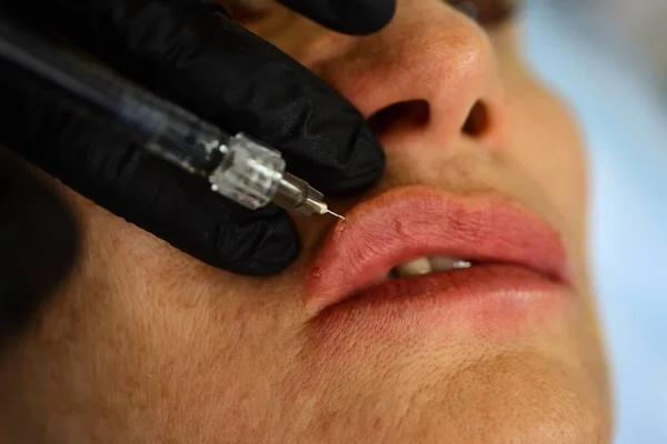 Primeros labios de mujer, aumento del procedimiento. Jeringa de boca femenina, inyección de ácido hialurónico, aumento. Cambios de edad. Cosmetología Tratamiento. —  Fotos de Stock