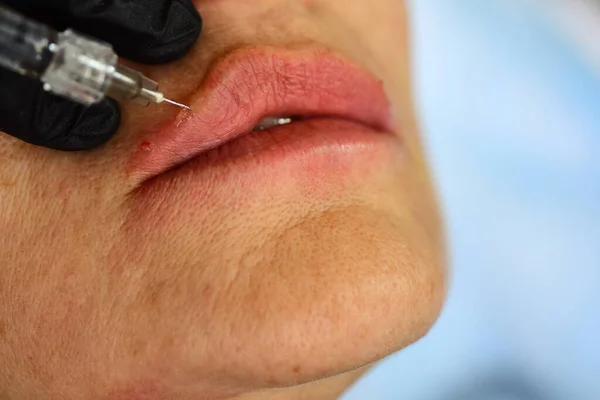 Lábios de mulher de close-up, aumento de procedimento. Xarope boca feminina, injeção de ácido hialurônico, aumento. A idade muda. Cosmetologia Tratamento. — Fotografia de Stock