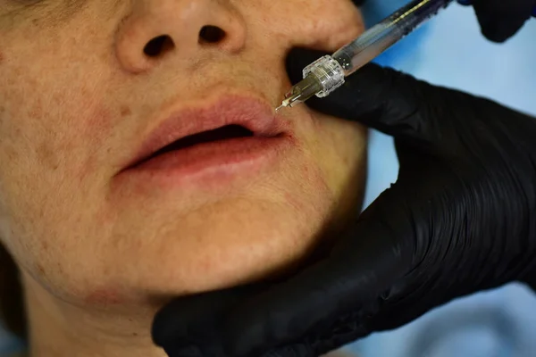 Primeros labios de mujer, aumento del procedimiento. Jeringa de boca femenina, inyección de ácido hialurónico, aumento. Cambios de edad. Cosmetología Tratamiento. —  Fotos de Stock