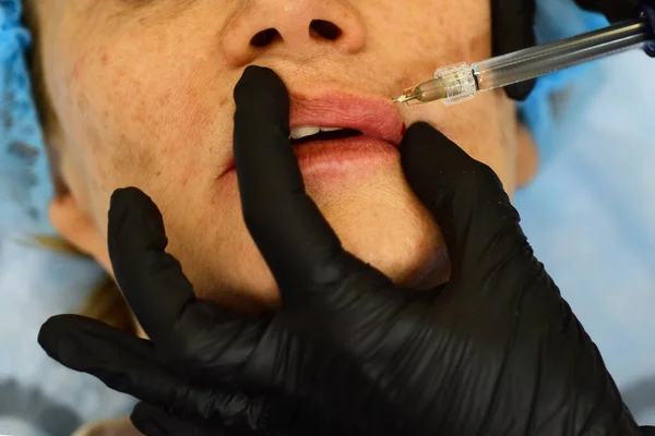 Primeros labios de mujer, aumento del procedimiento. Jeringa de boca femenina, inyección de ácido hialurónico, aumento. Cambios de edad. Cosmetología Tratamiento. —  Fotos de Stock
