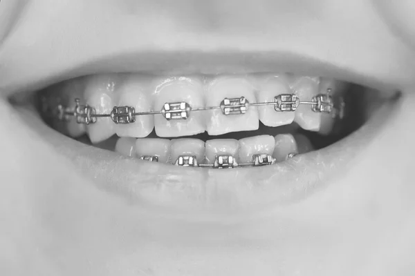 Primer plano de los dientes entre paréntesis — Foto de Stock