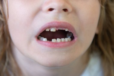 Diş boşluğu gösteren bir çocuk. Bebek dişlerinin kapanışı. Çocuğun süt dişleri dökülüyor. Çocuk ağzı ve yeni dişler. Dişsiz gülüşlü çocuk. Çocuklar dişlerini kaybetti. Çocuk diş konsepti