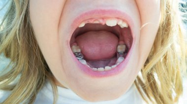 Diş aralığı olan bir çocuk. Dişçi çocuk ağzını kapatmış. Yeni dişler çıkıyor. Toothless çocuklarının diş tebessümü. Çocuğun dişleri dökülüyor. Diş büyümesi. Diş bakımı. Kapalı çocuk ağzı. Diş tedavisi, çocuk bakımı.