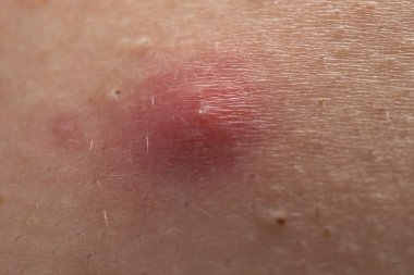 Sivilce sivilcesi. Sivilce şişlikleriyle cilt sorunu. Sivilce dokusu tahriş olmuş. Sivilce sorununu kapat