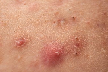 Sivilce sivilcesi. Sivilce şişlikleriyle cilt sorunu. Sivilce dokusu tahriş olmuş. Sivilce sorununu kapat