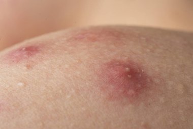 Sivilce sivilcesi. İltihaplı şişliklerle cilt sorunu. Tahriş olmuş deri dokusu. Cilt sorununu kapat