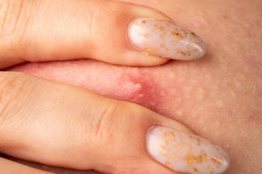 İltihaplı deri şişlikleri akne makro. Sivilceli makro deri tahrişi. Sivilceli ayrıntılı deri. Derideki sivilceleri kapatın.