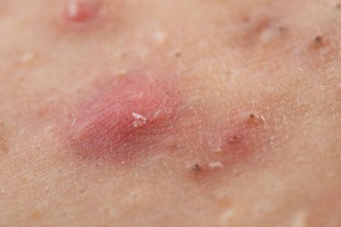 Sivilce sivilcesi. Sivilce çıkıntılarıyla cilt sorunu. Sinirli Sivilce dokusu. Sivilce sorununu kapat