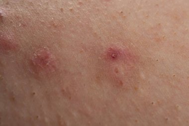 Sivilceli, yakından çekilmiş bir fotoğraf. Sivilce dokusu olan tahriş olmuş bir cilt. Epidermiyi iltihaplı foliküller ve sivilcelerle kapatın. Sivilceli ayrıntılı cilt