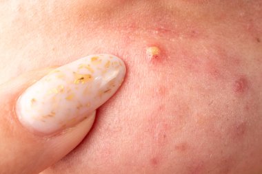 Sivilceli makro deri tahrişi. İltihaplı deri şişlikleri akne makro. Sivilceli ayrıntılı deri. Sivilceli deri döküntüsü.