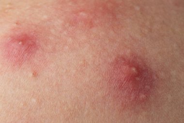 Sivilceli, yakından çekilmiş bir fotoğraf. İltihaplı deri şişlikleri akne makro. Sivilce gözenekleri olan dermatoloji konsepti. Sivilceli ayrıntılı cilt