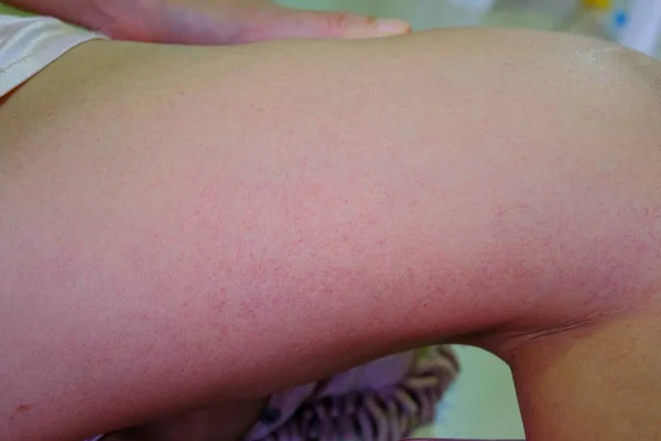 Das Bein Einer Frau Die Sich Von Dem Durch Mücken — Stockfoto
