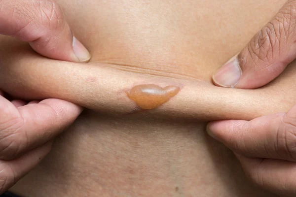 Blister z oparzeniem skóry z bliska — Zdjęcie stockowe