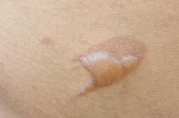Primo piano blister da scottatura sulla pelle — Foto Stock