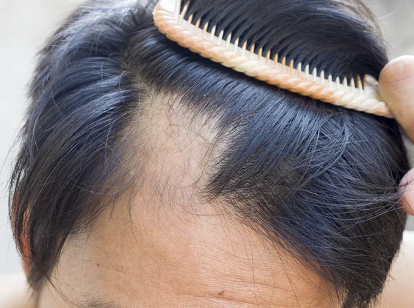 Homem é perda de cabelo com pente . — Fotografia de Stock