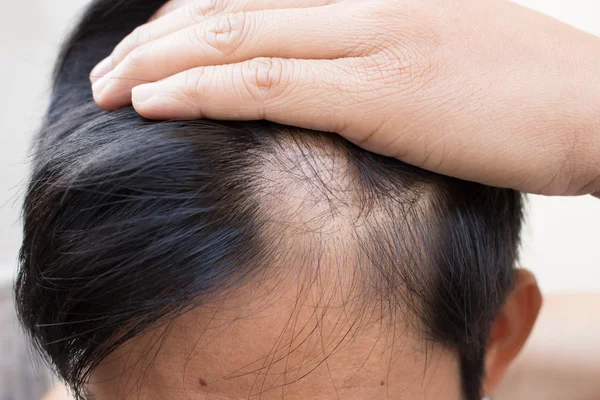 Hair Shedding vs Hair Loss Treatment | Stock Photo