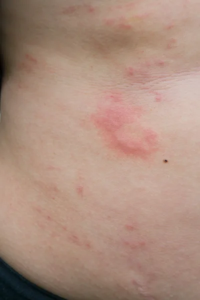 Een vrouw is urticaria op buik — Stockfoto