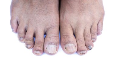 ayak tirnagi enfeksiyonlar