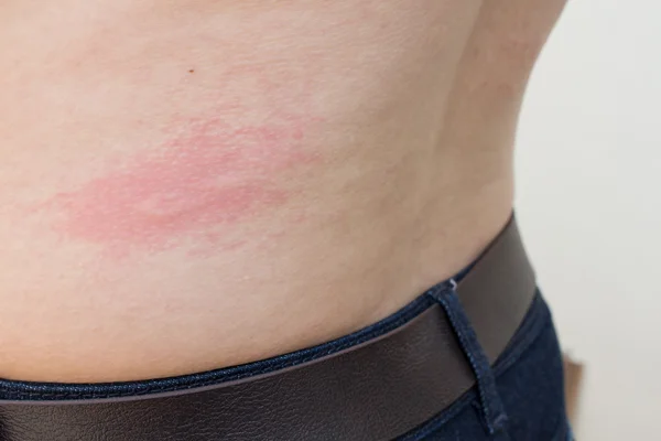 Een vrouw is urticaria op rug — Stockfoto