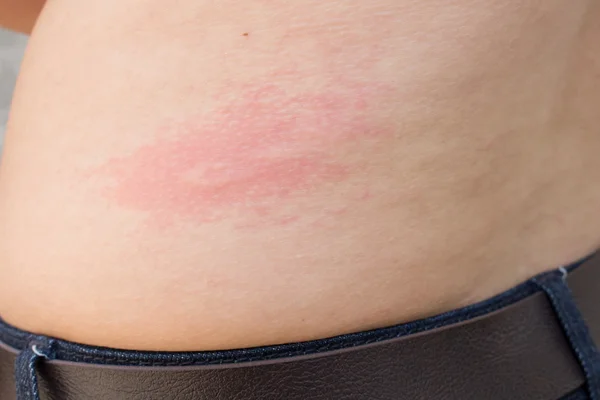 A woman is urticaria on back — Stock Photo, Image
