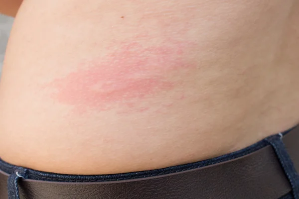 Een vrouw is urticaria op rug — Stockfoto