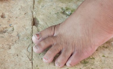 Yaşlı kadın ayak, mantar