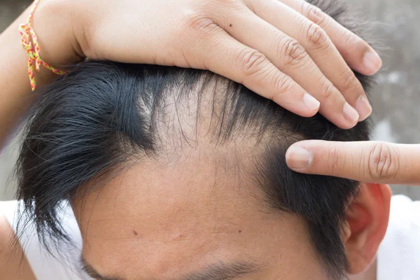 Člověk je ztráta vlasů s vlasy hřebenem. — Stock fotografie