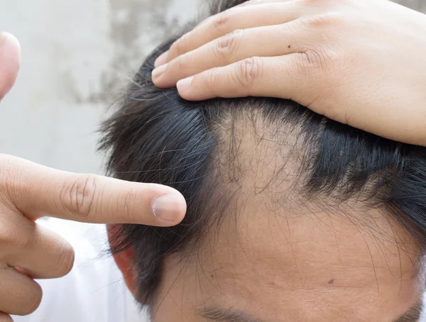 Homem é a perda de cabelo com pente de cabelo . — Fotografia de Stock