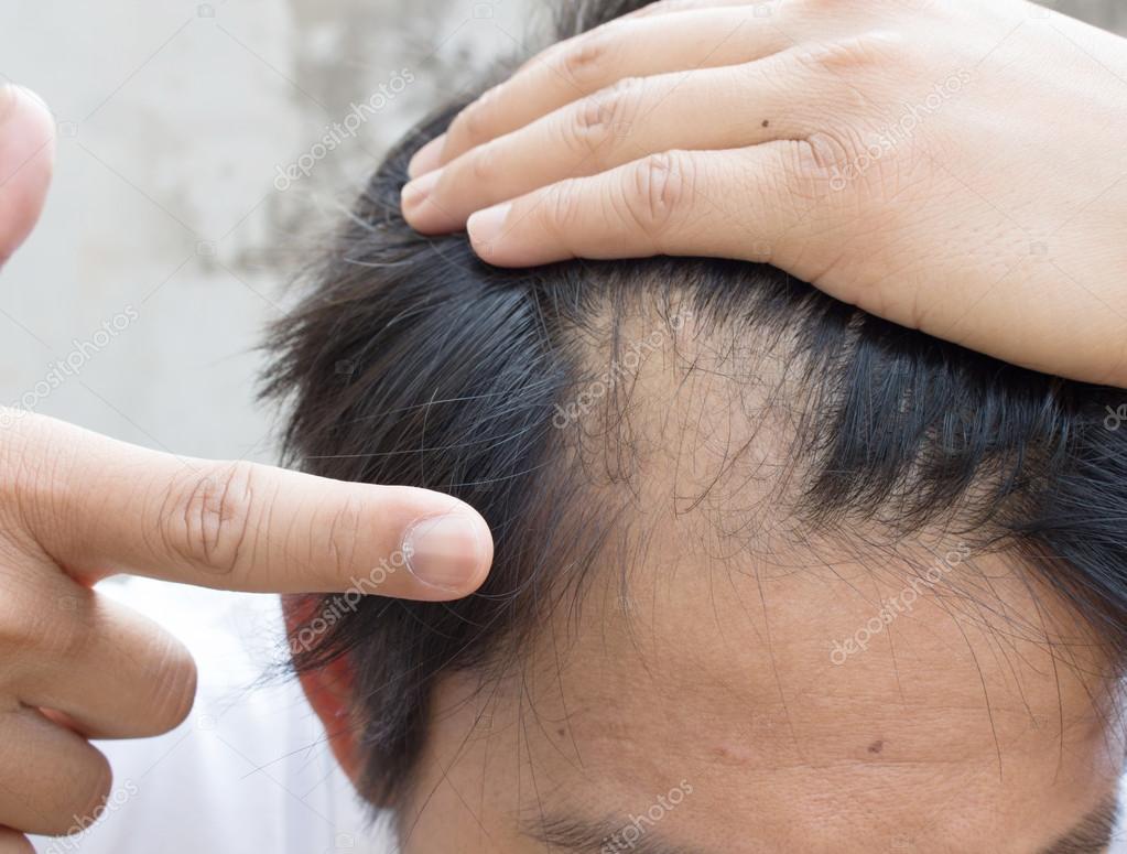 Выпасть из головы. Волосы у мужчин на голове. Выпасть из головы. Выпасть из головы. Проплешина на голове у мужчин.