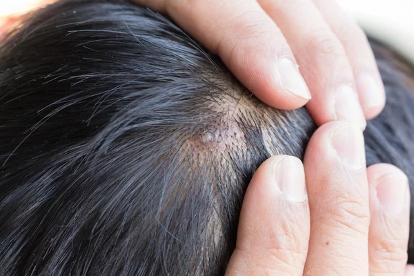 Skin disease on the head — Stock Photo, Image