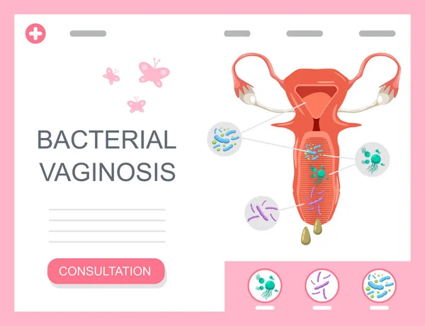 Bakterielle Vaginose Medizinische Infografiken Mit Weiblichem Fortpflanzungsorgan Mit Bakterien Und lizenzfreie Stockillustrationen